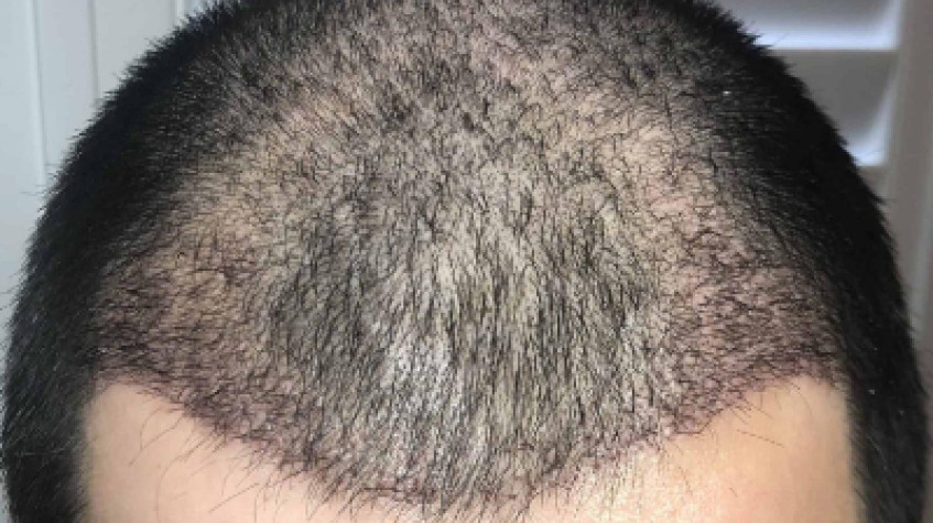 3 Days Gold Package Hair Transplant Package