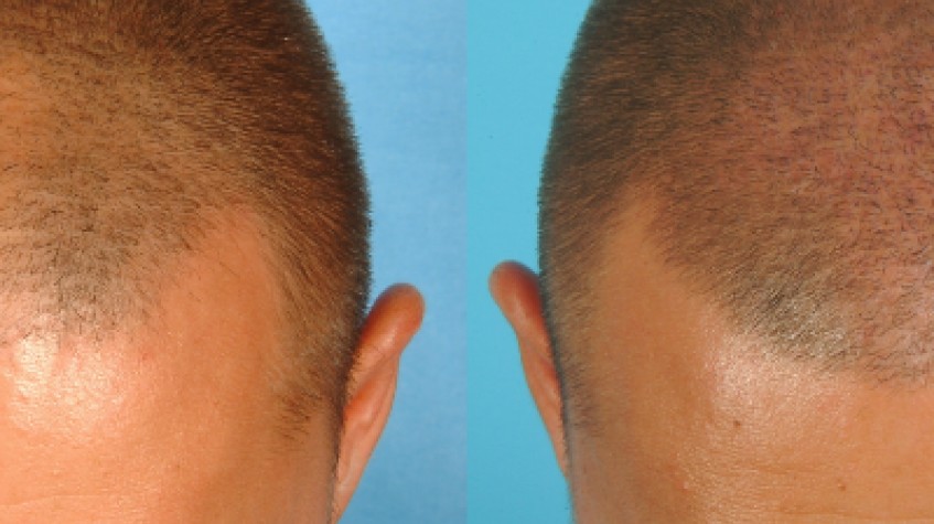 3 Days Gold Package Hair Transplant Package